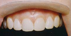 Enamel Shaping - After